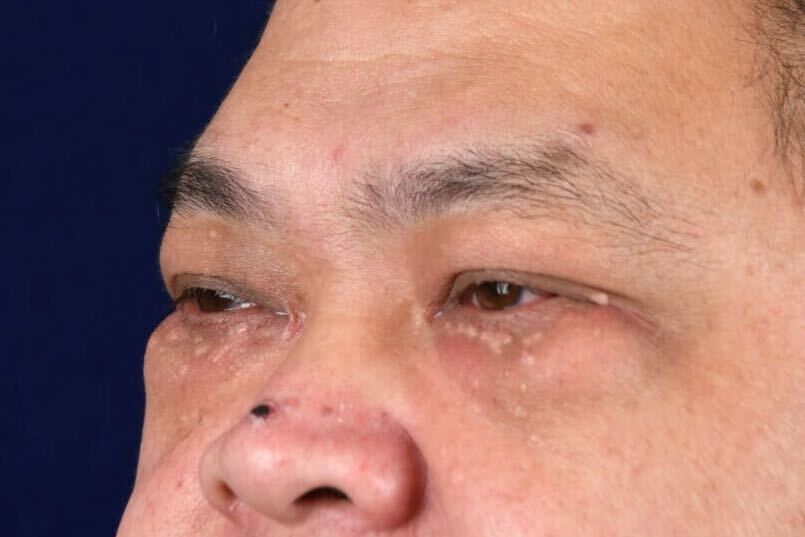 Lower Blepharoplasty Before & After