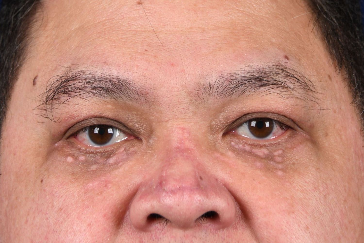 Lower Blepharoplasty Before & After