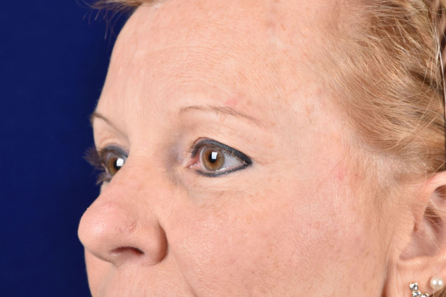Upper Blepharoplasty Before & After