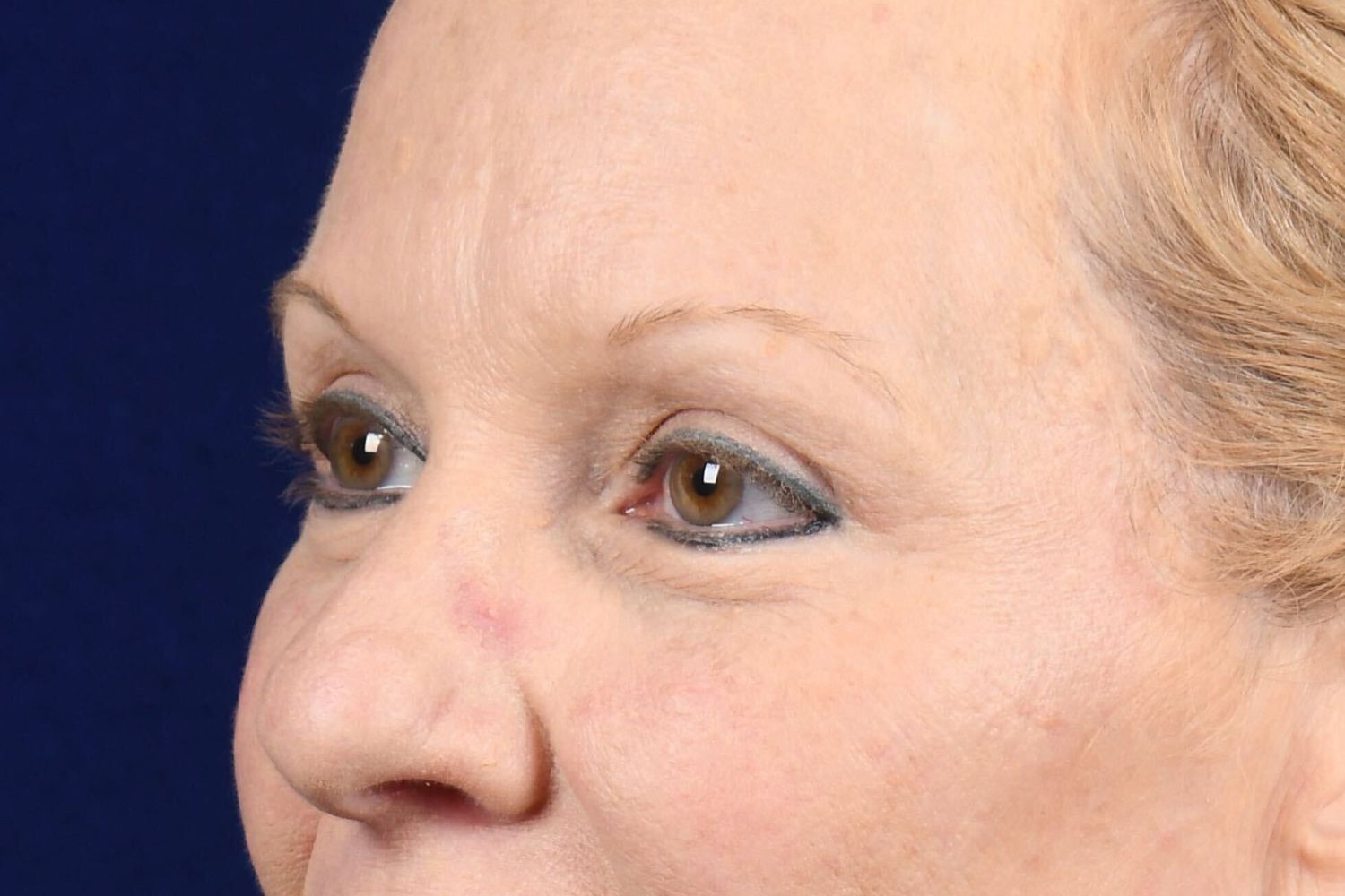 Upper Blepharoplasty Before & After