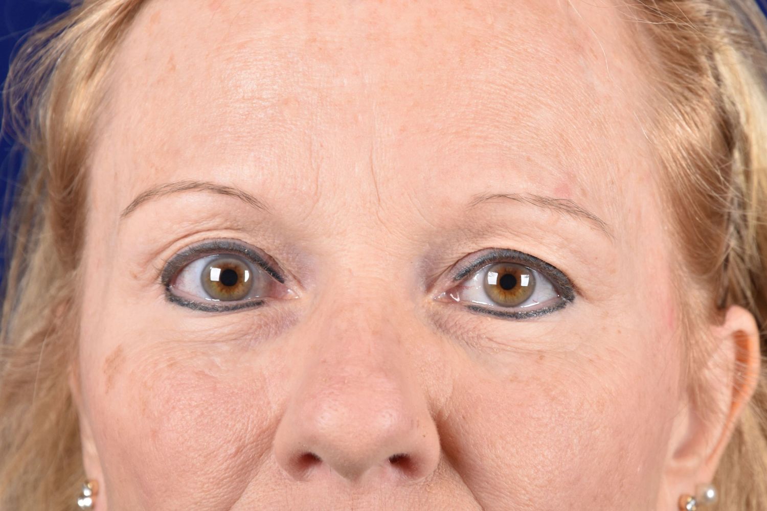 Upper Blepharoplasty Before & After