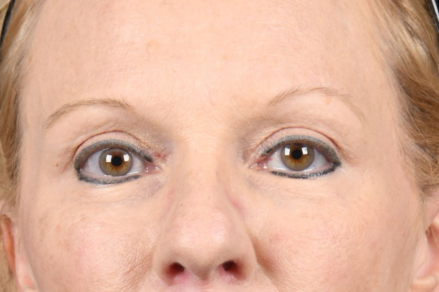 Upper Blepharoplasty Before & After