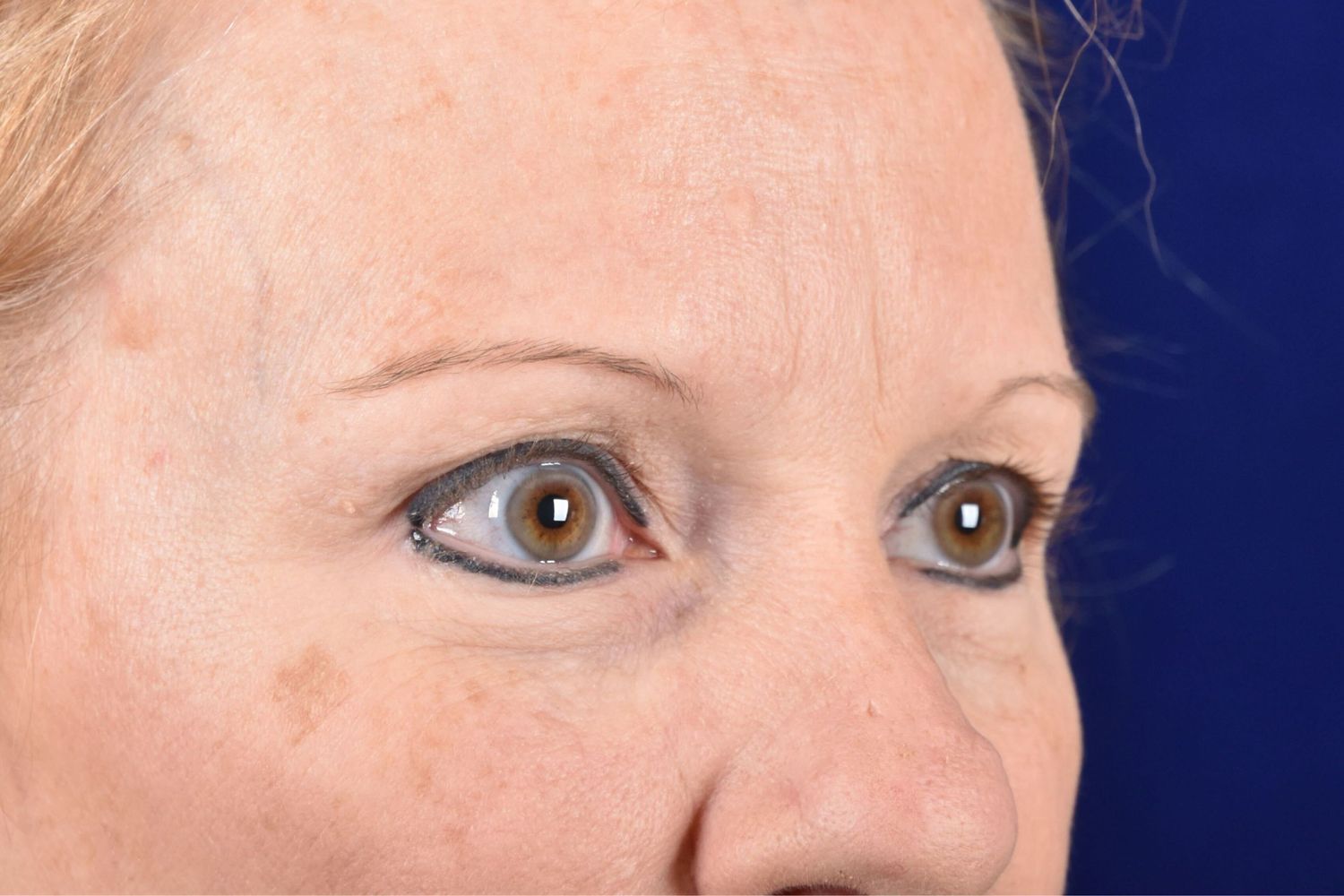 Upper Blepharoplasty Before & After