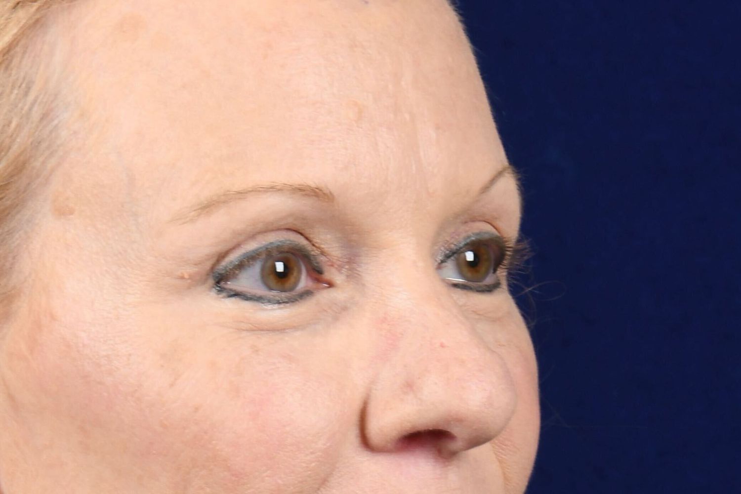 Upper Blepharoplasty Before & After