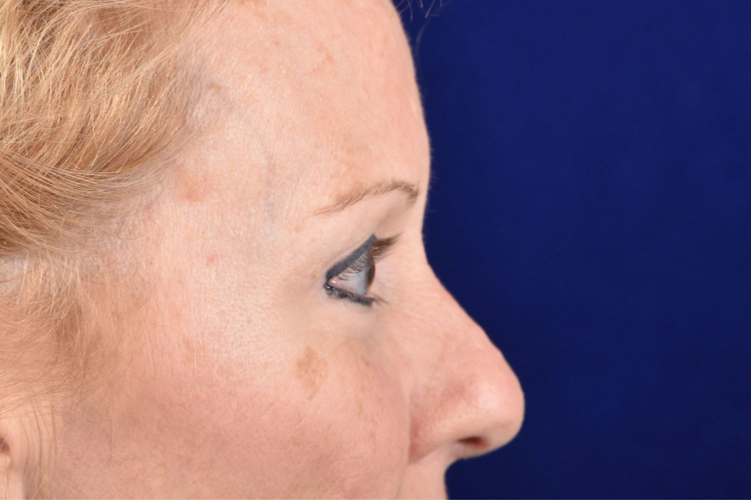 Upper Blepharoplasty Before & After