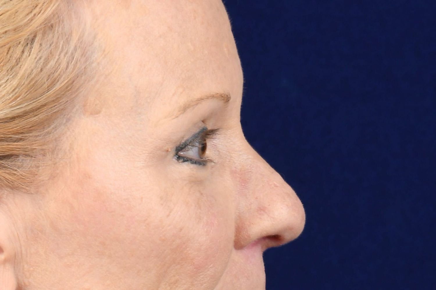 Upper Blepharoplasty Before & After