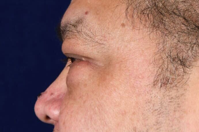 Upper Blepharoplasty Before & After