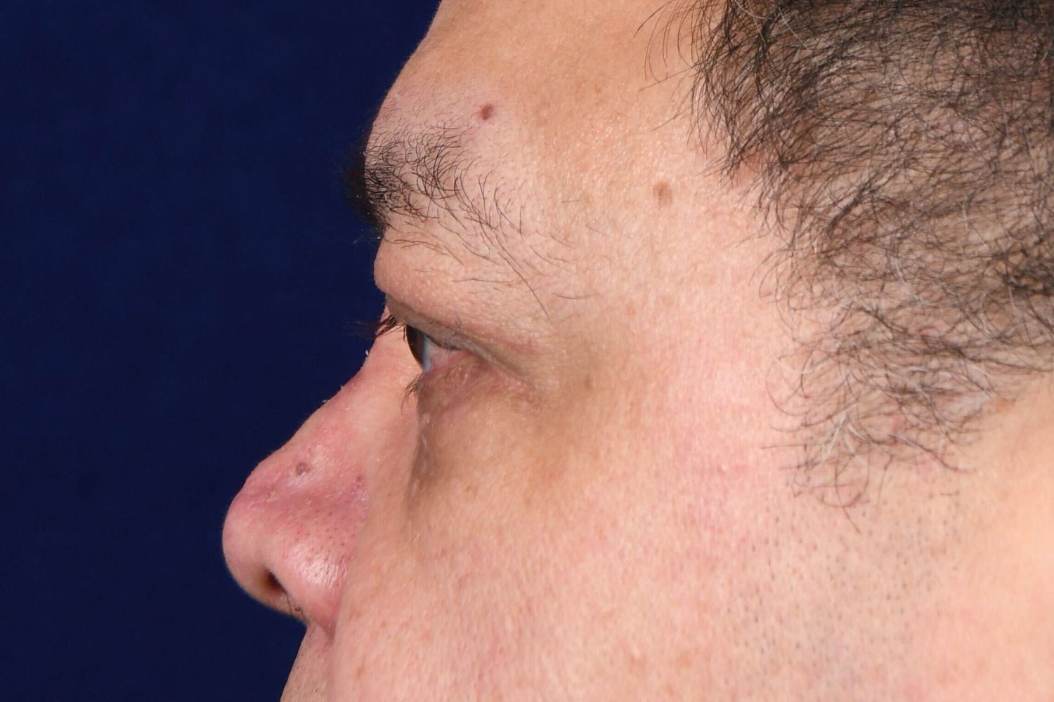 Upper Blepharoplasty Before & After