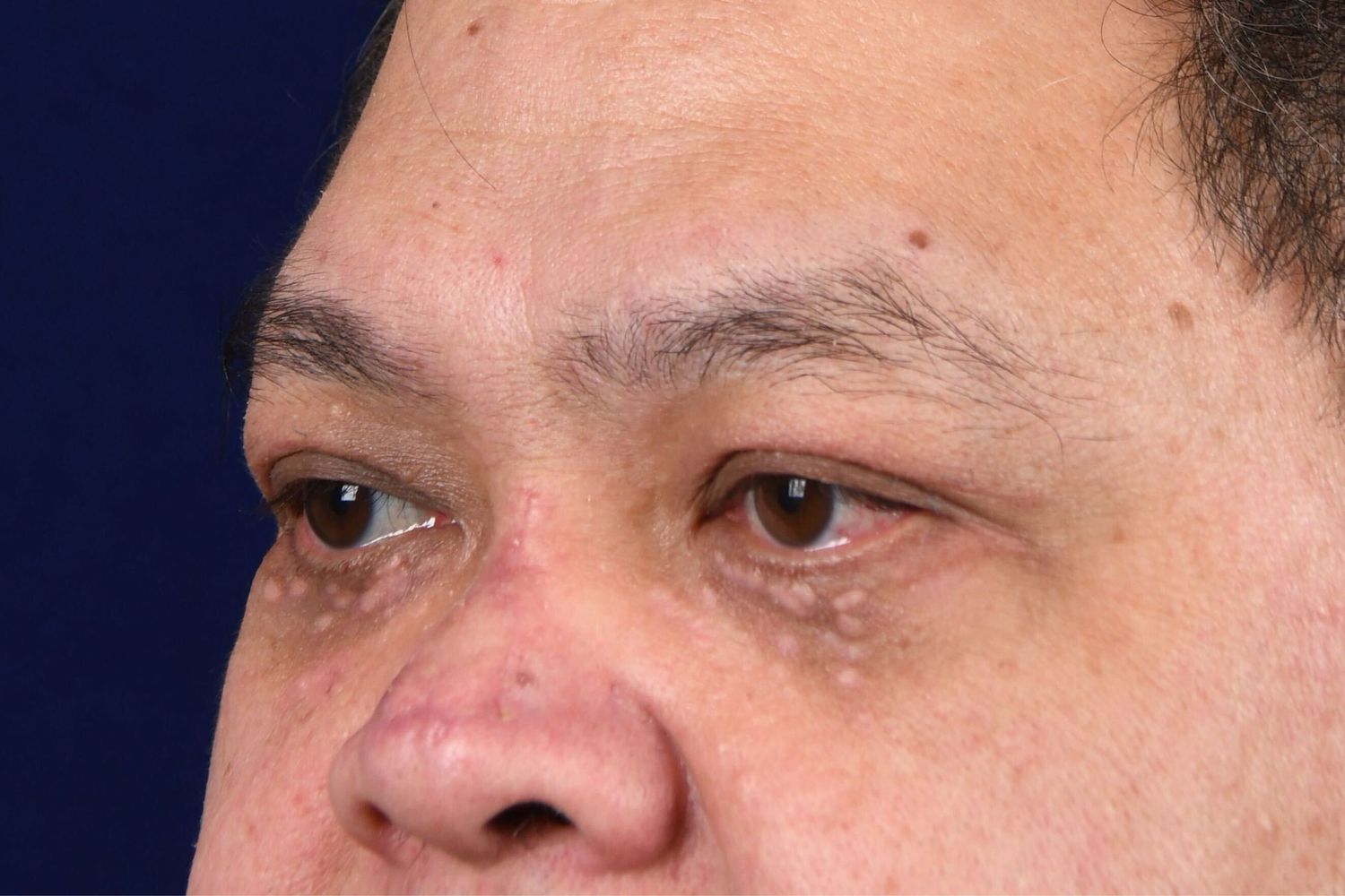 Upper Blepharoplasty Before & After