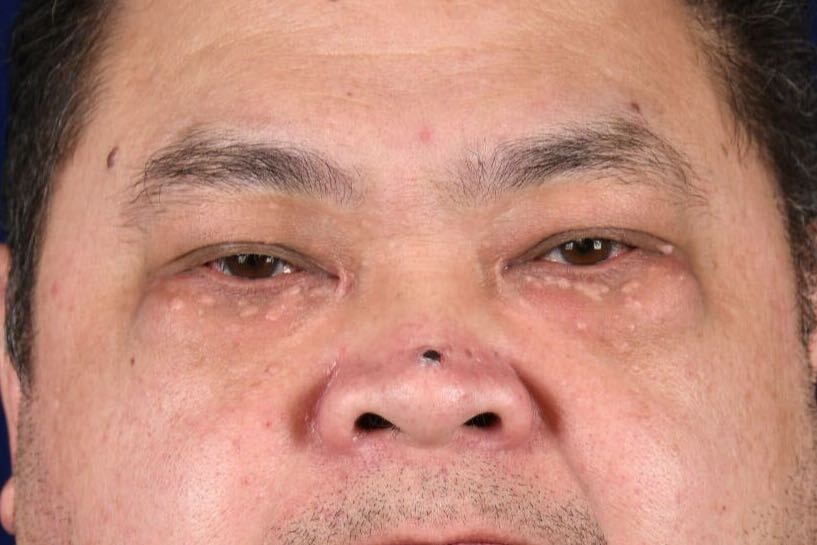 Upper Blepharoplasty Before & After