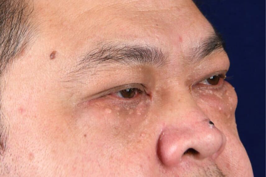 Upper Blepharoplasty Before & After