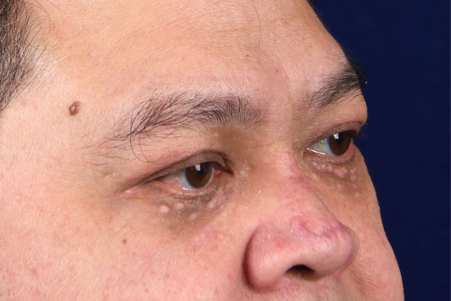 Upper Blepharoplasty Before & After