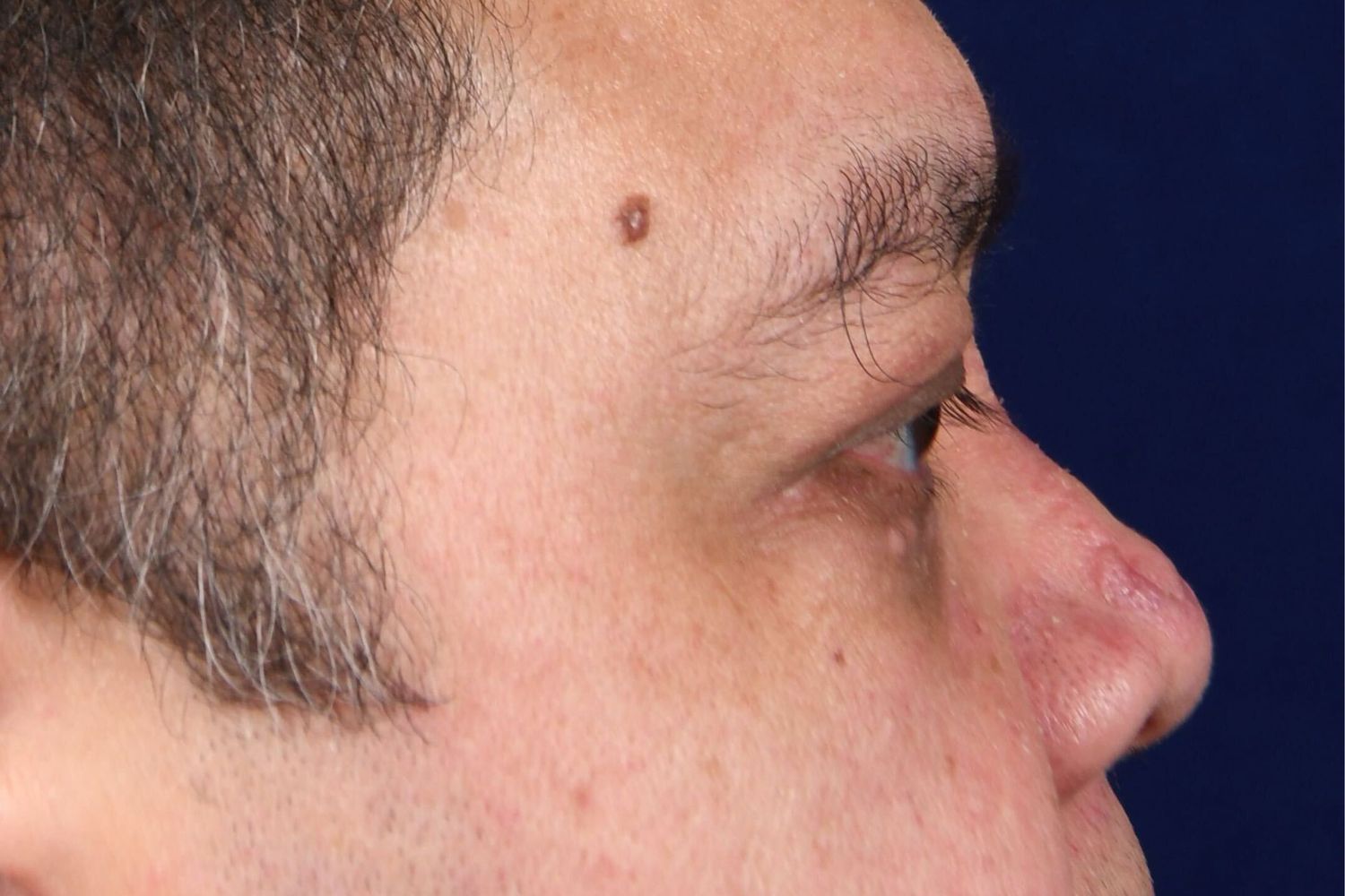 Upper Blepharoplasty Before & After