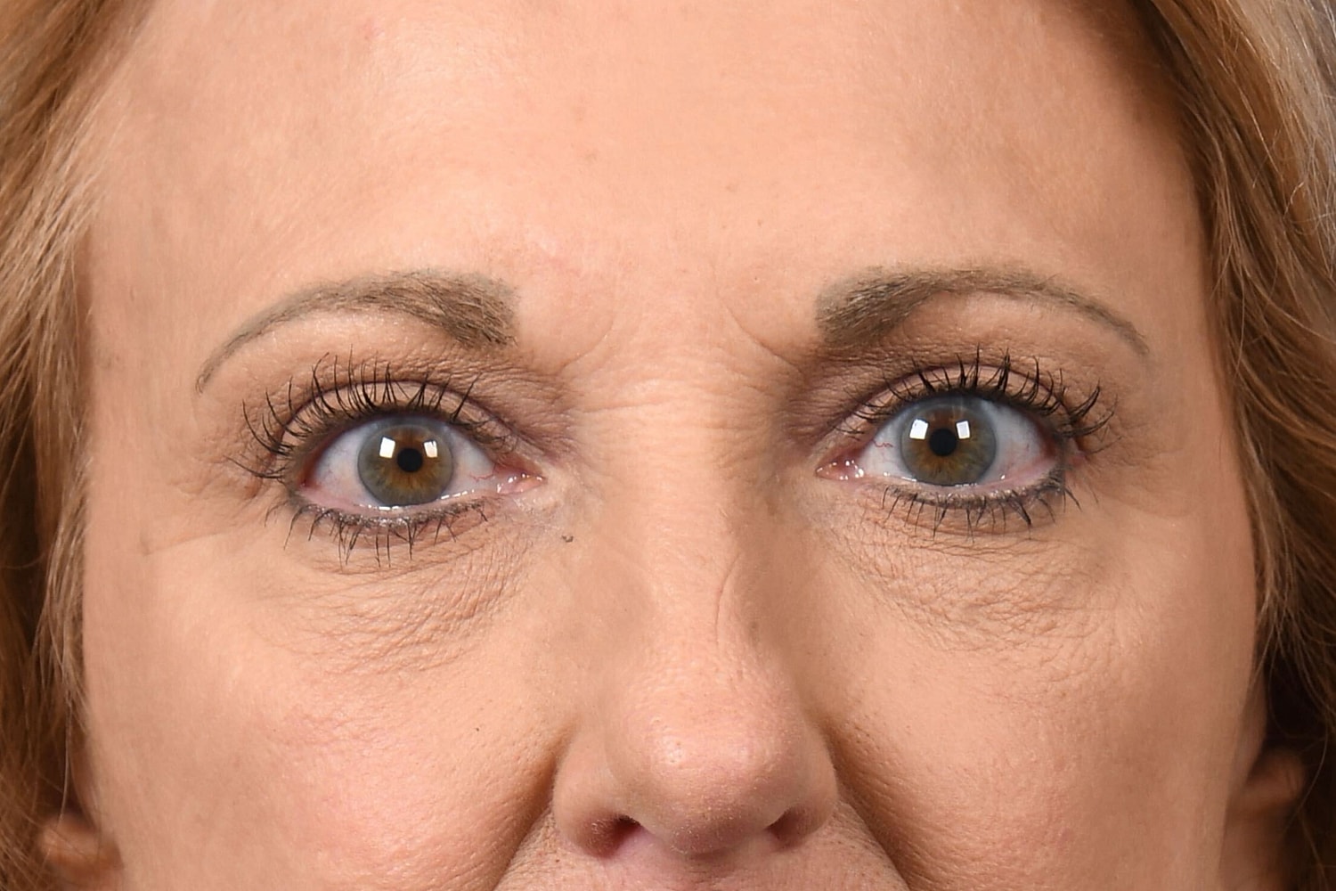 Upper Blepharoplasty Before & After