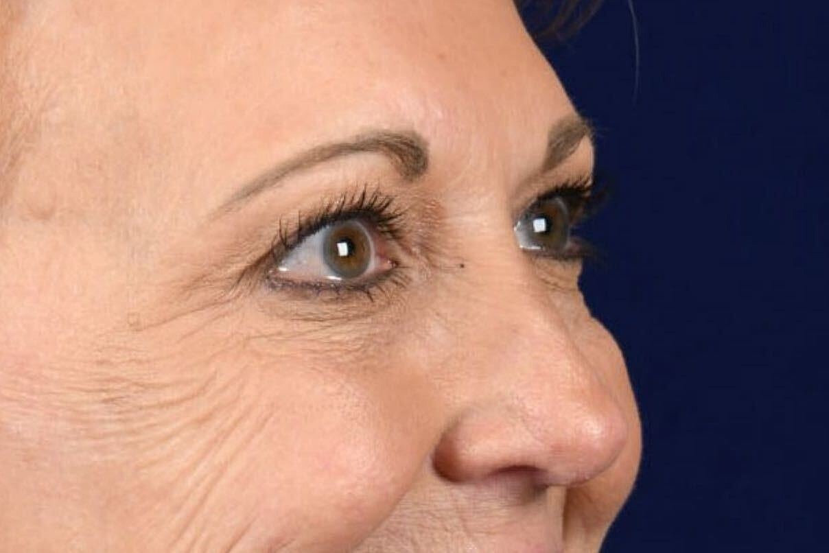 Upper Blepharoplasty Before & After
