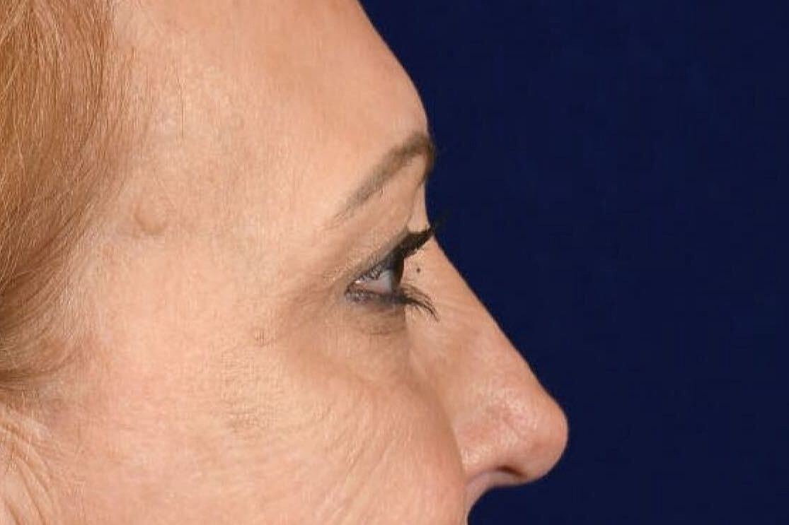 Upper Blepharoplasty Before & After