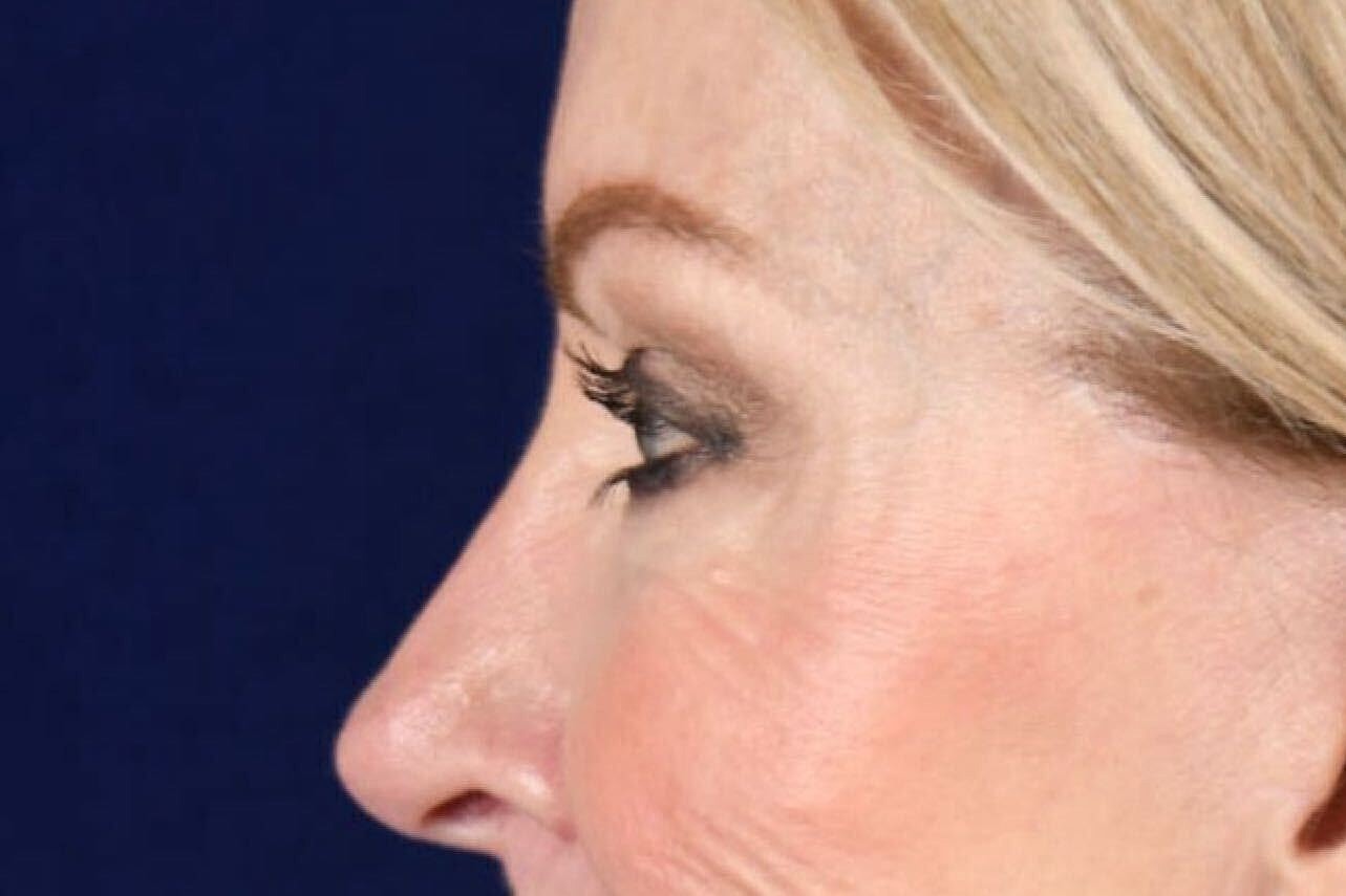 Upper Blepharoplasty Before & After