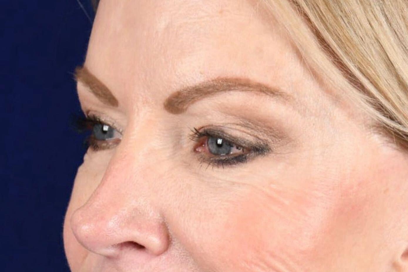 Upper Blepharoplasty Before & After