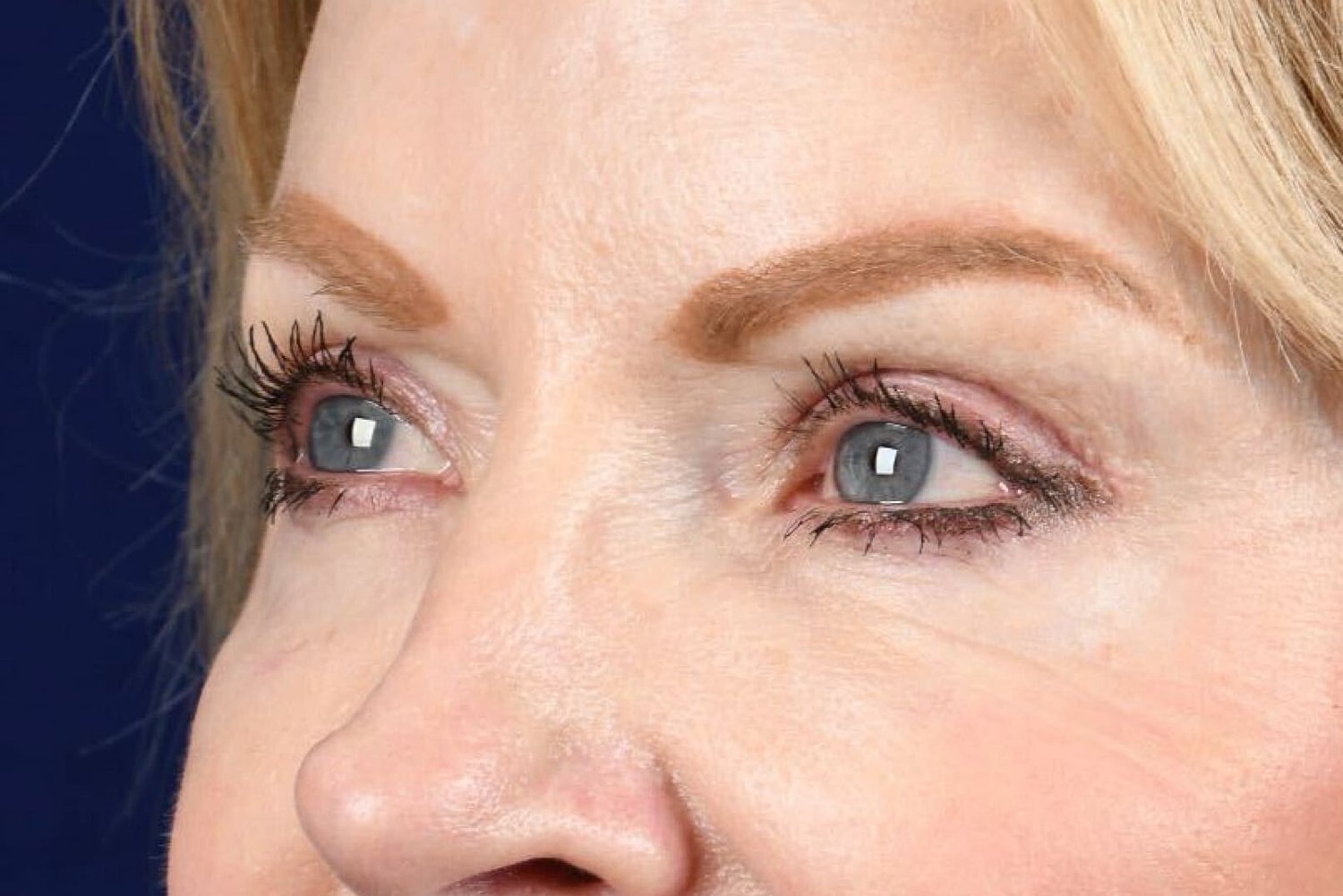 Upper Blepharoplasty Before & After