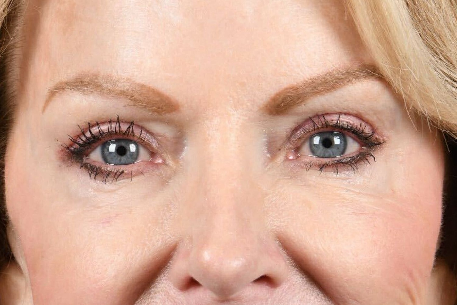Upper Blepharoplasty Before & After