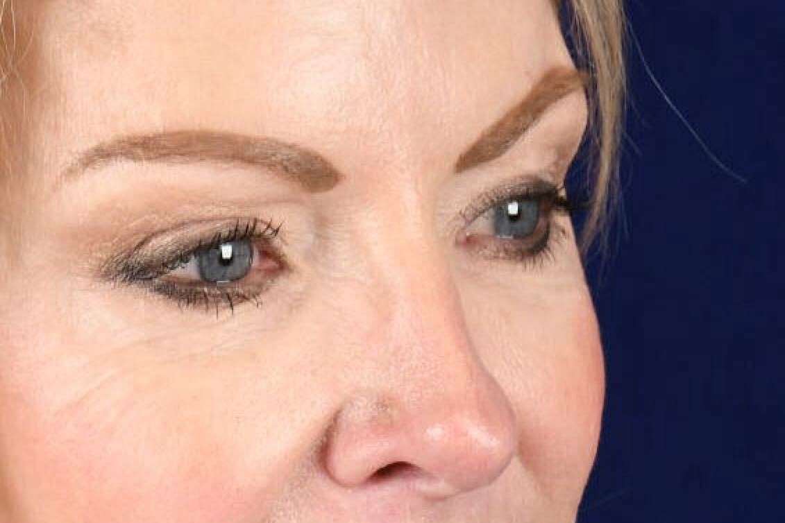 Upper Blepharoplasty Before & After