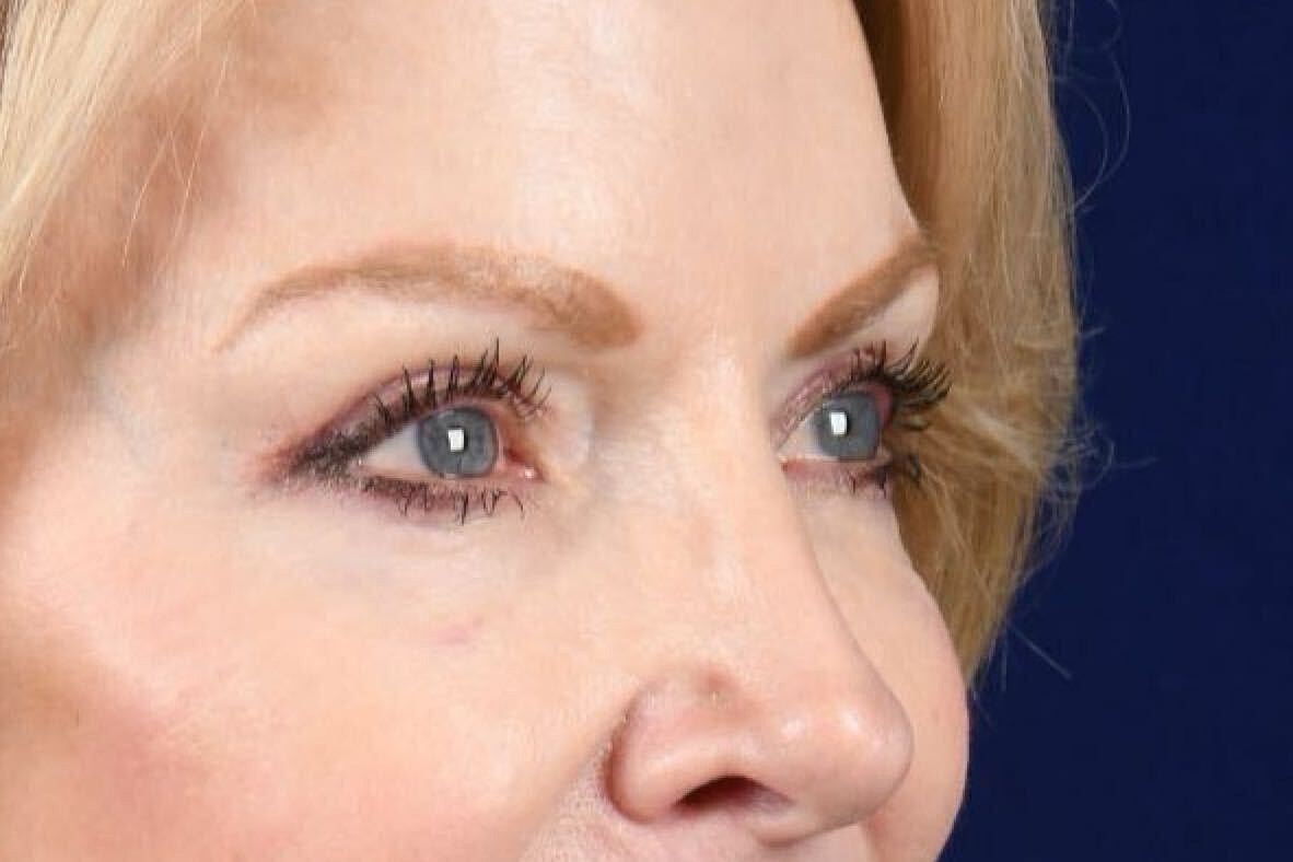 Upper Blepharoplasty Before & After
