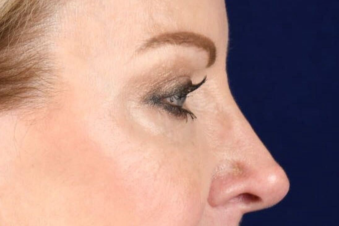 Upper Blepharoplasty Before & After