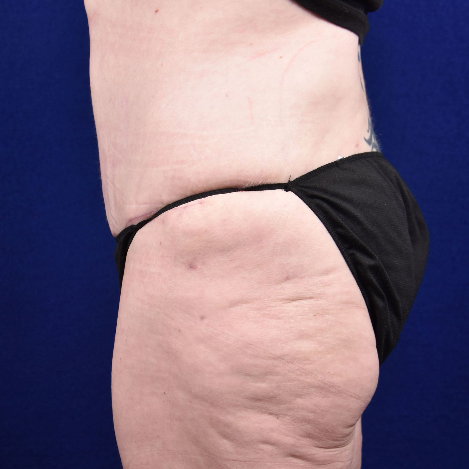 Abdominoplasty Lipo Before & After