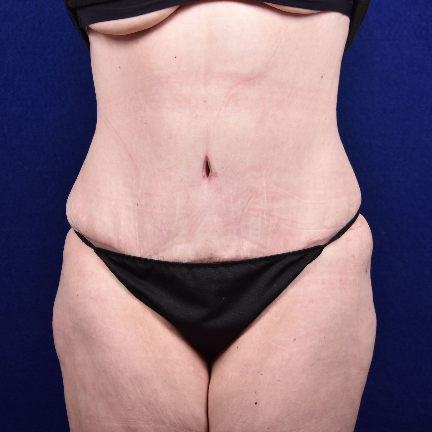Abdominoplasty Lipo Before & After