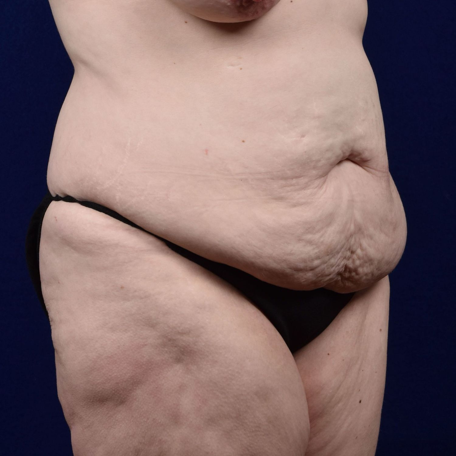 Abdominoplasty Lipo Before & After