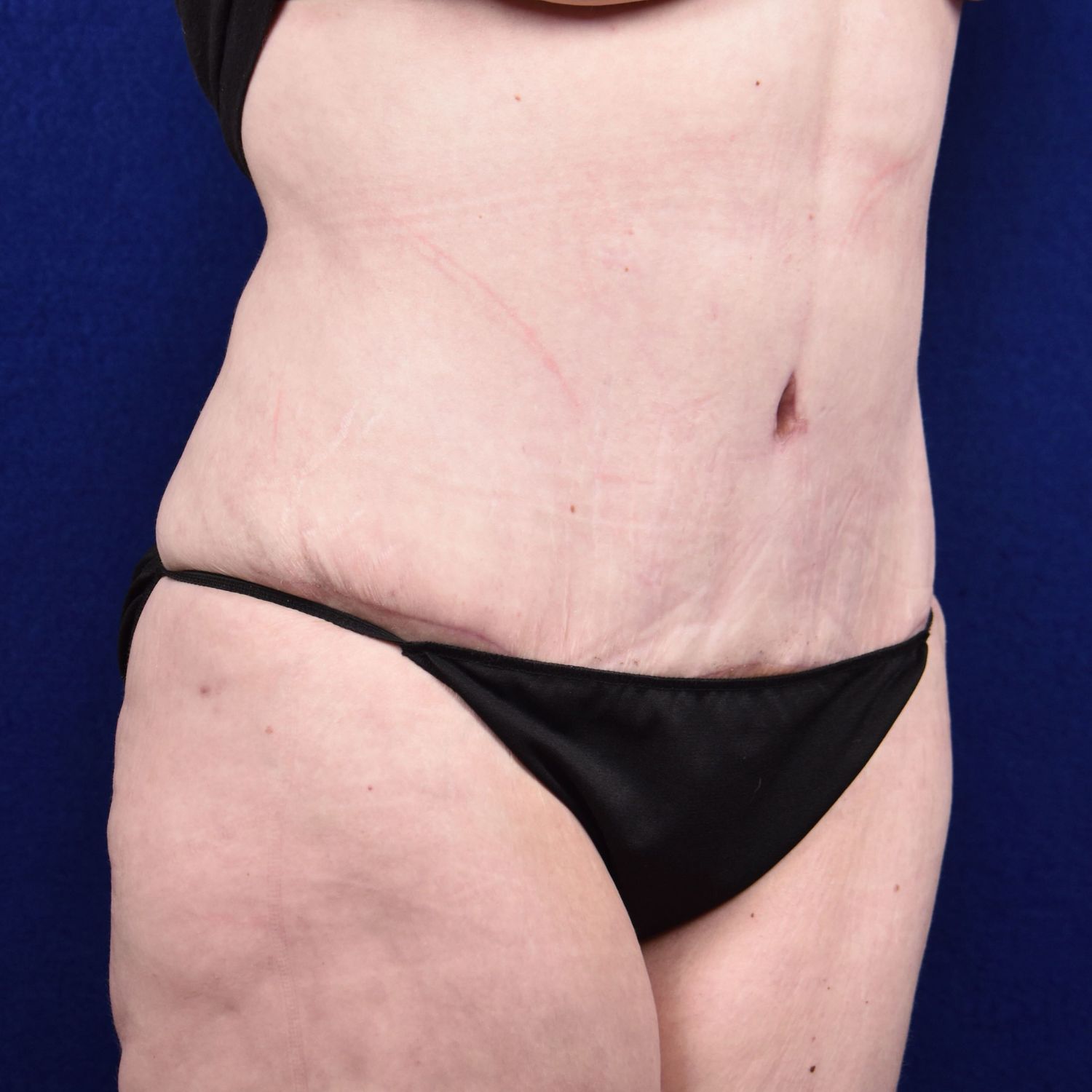 Abdominoplasty Lipo Before & After