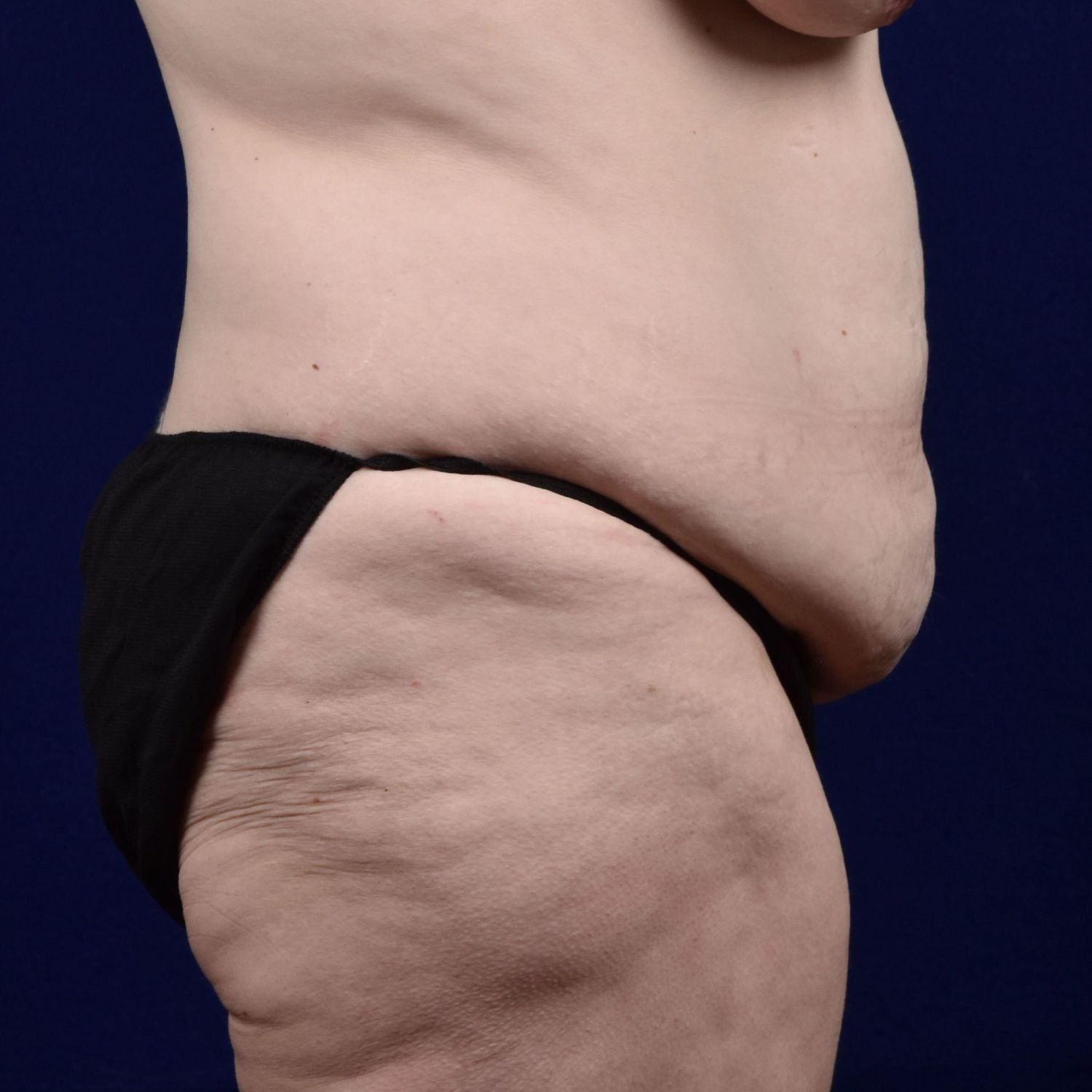 Abdominoplasty Lipo Before & After