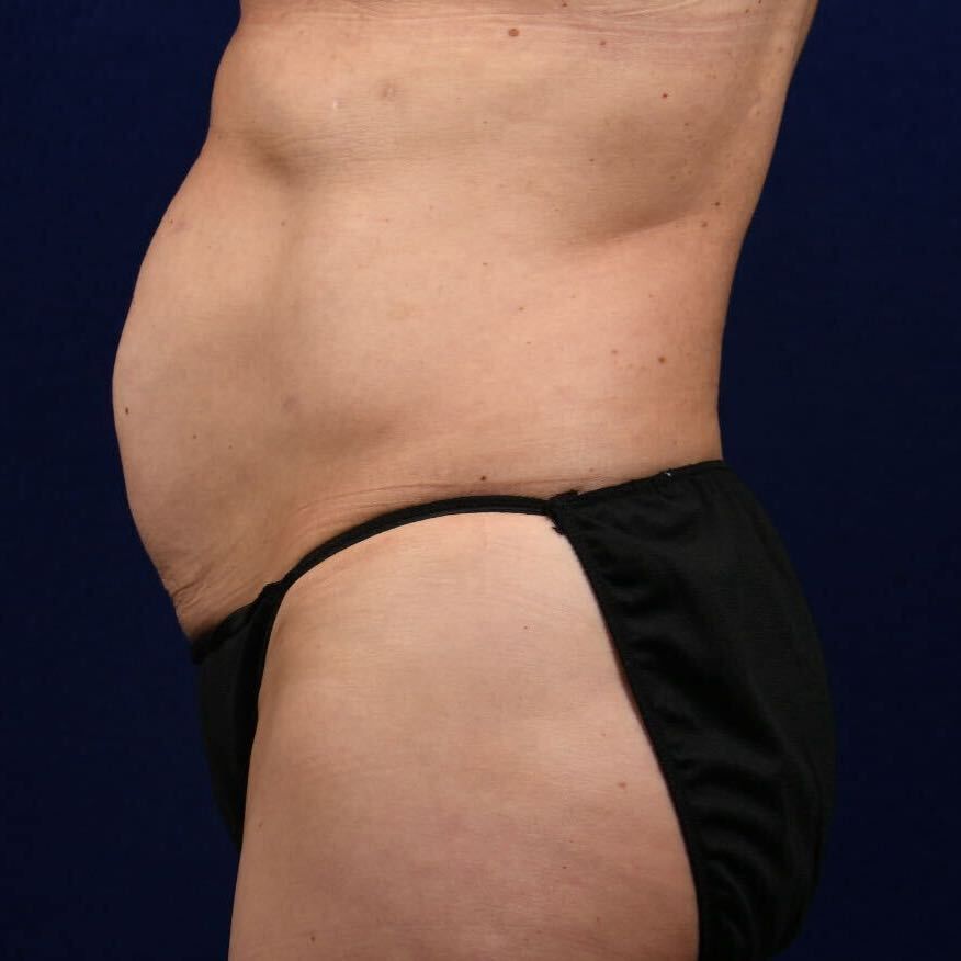 Abdominoplasty Lipo Before & After