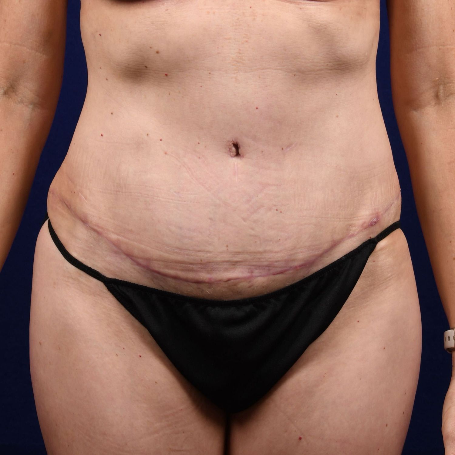 Abdominoplasty Lipo Before & After