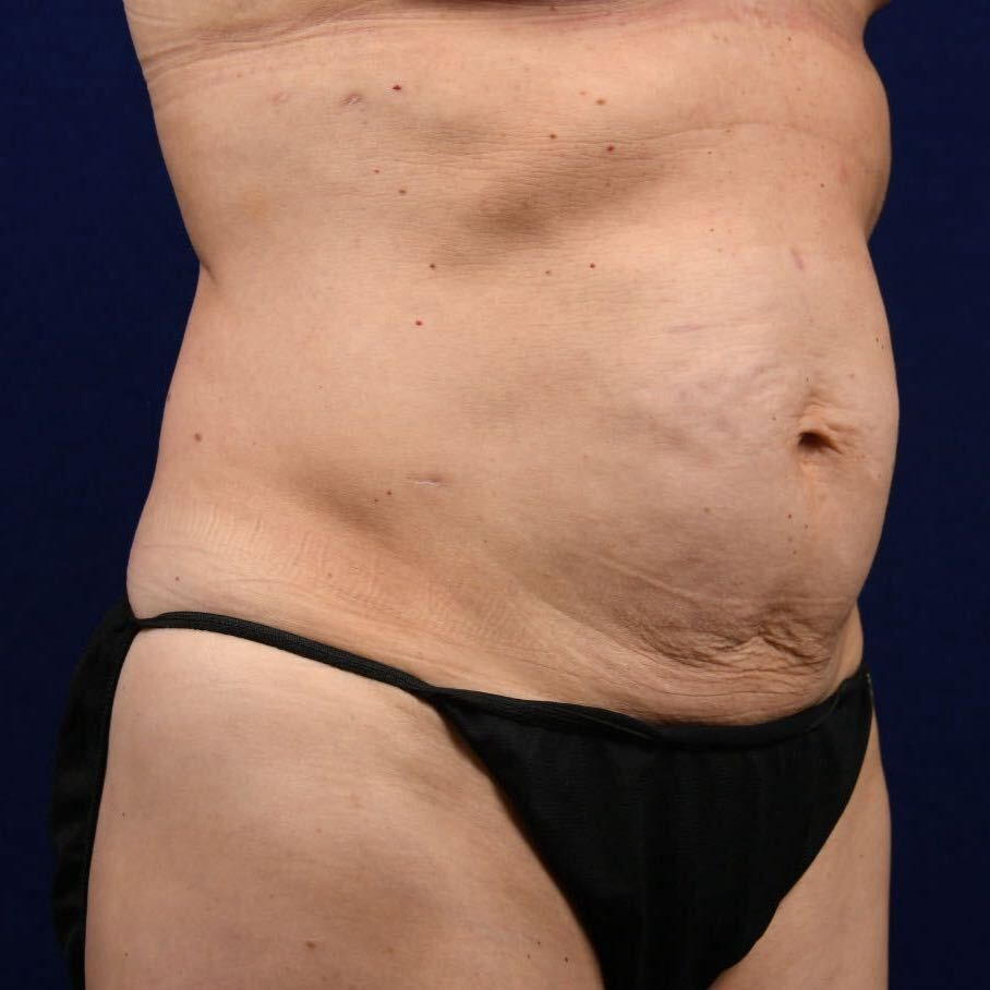 Abdominoplasty Lipo Before & After