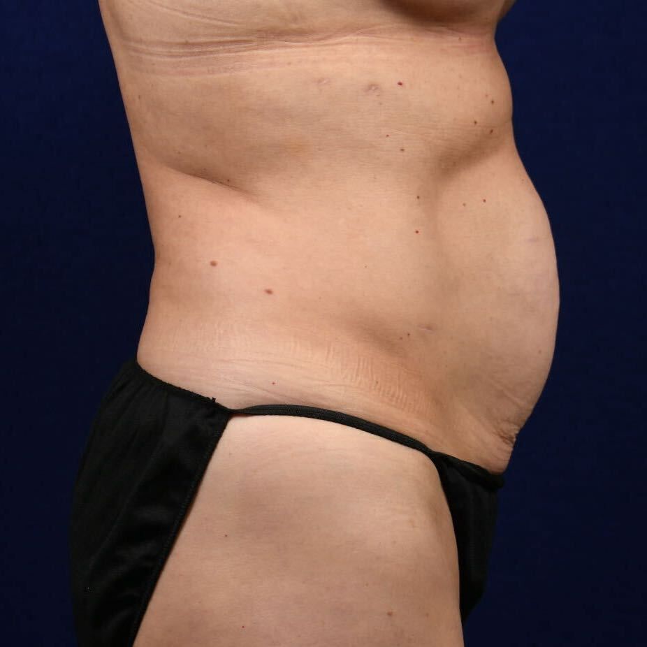 Abdominoplasty Lipo Before & After