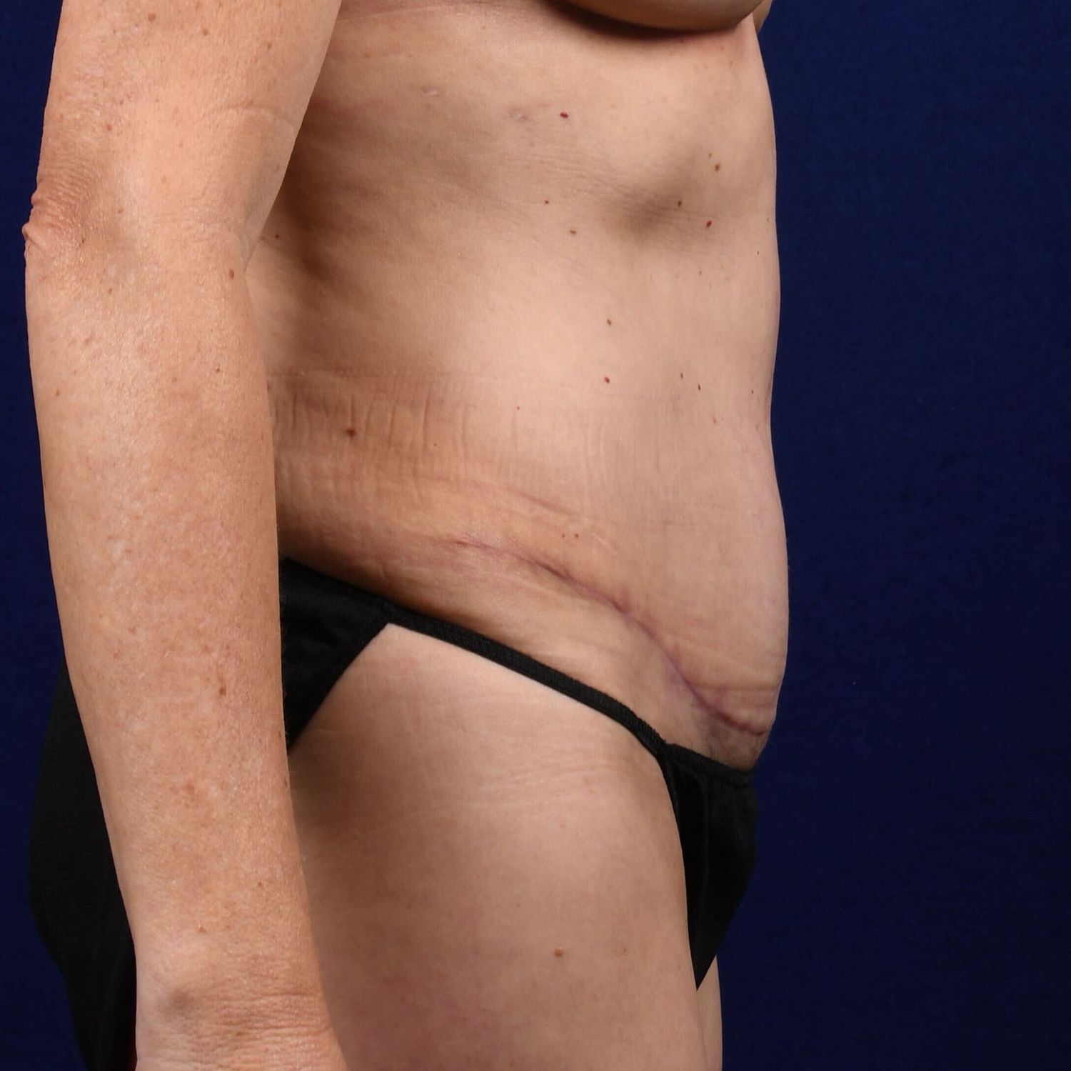 Abdominoplasty Lipo Before & After