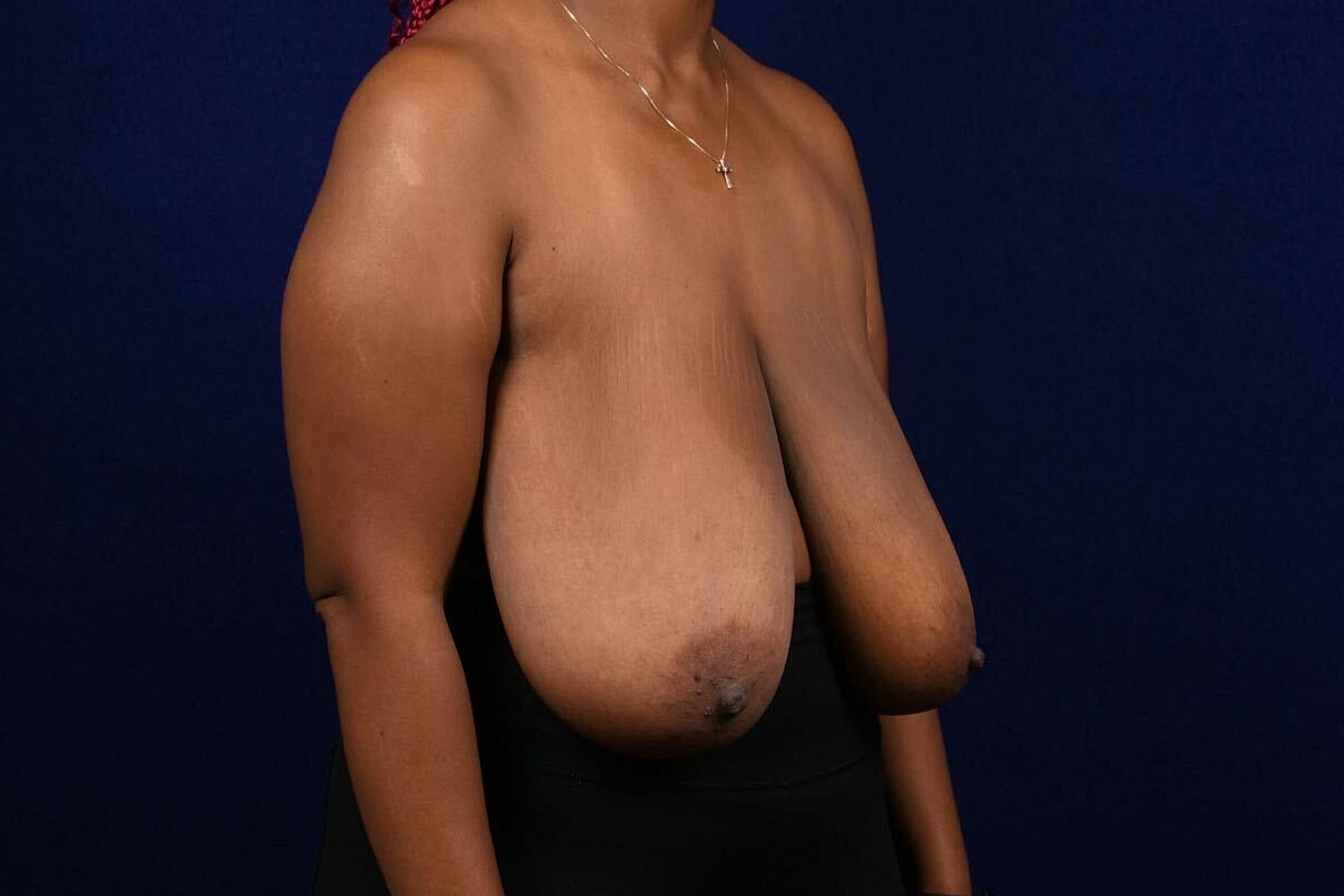 Breast Lift / Reduction Before & After