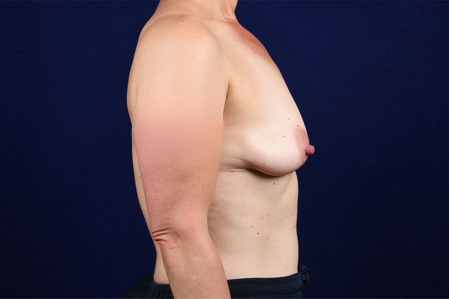 Breast Augmentation With Lift Before & After