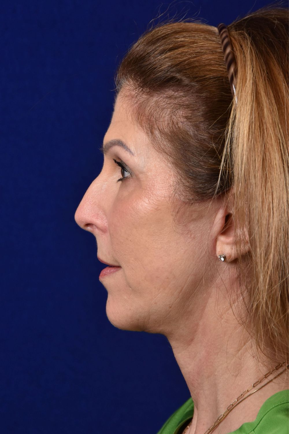 Facial Rejuvenation Before & After