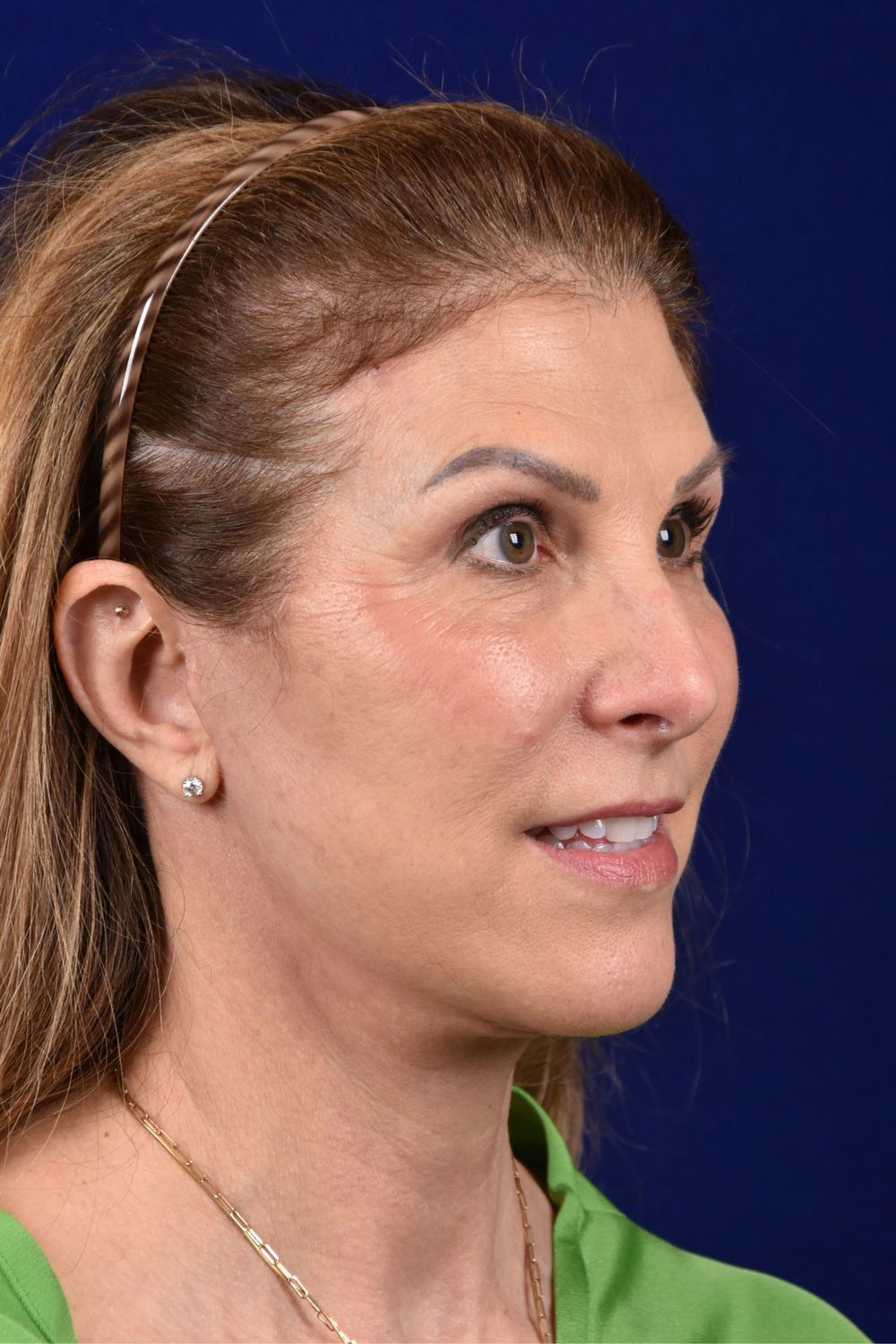 Facial Rejuvenation Before & After