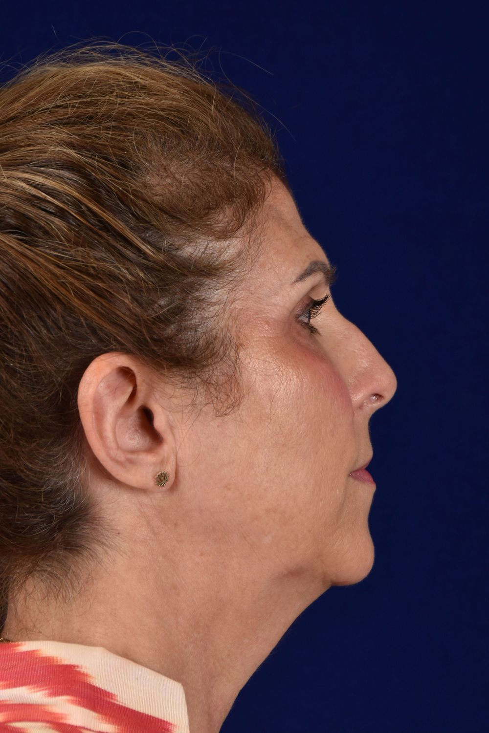 Facial Rejuvenation Before & After