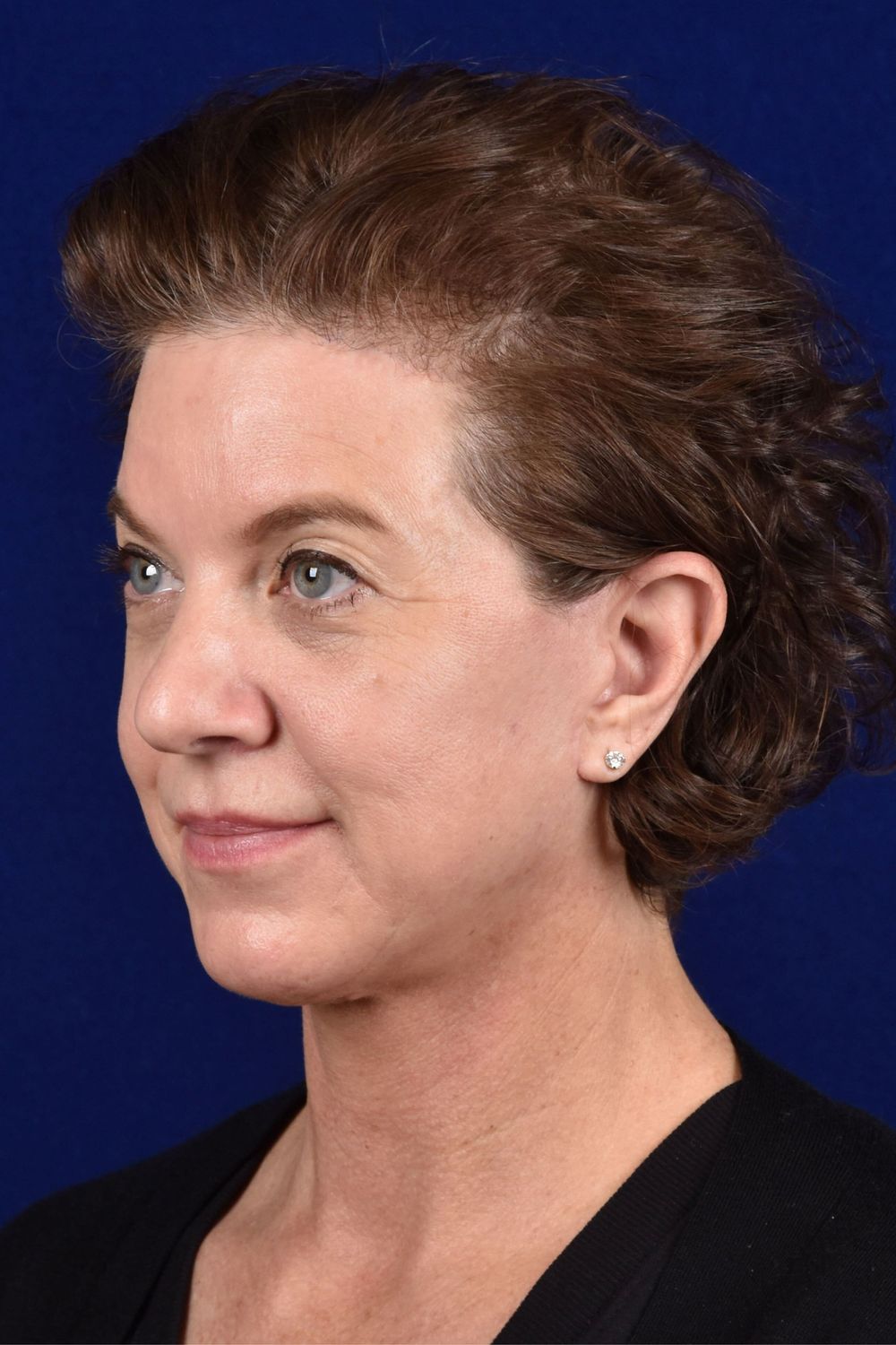 Facial Rejuvenation Before & After