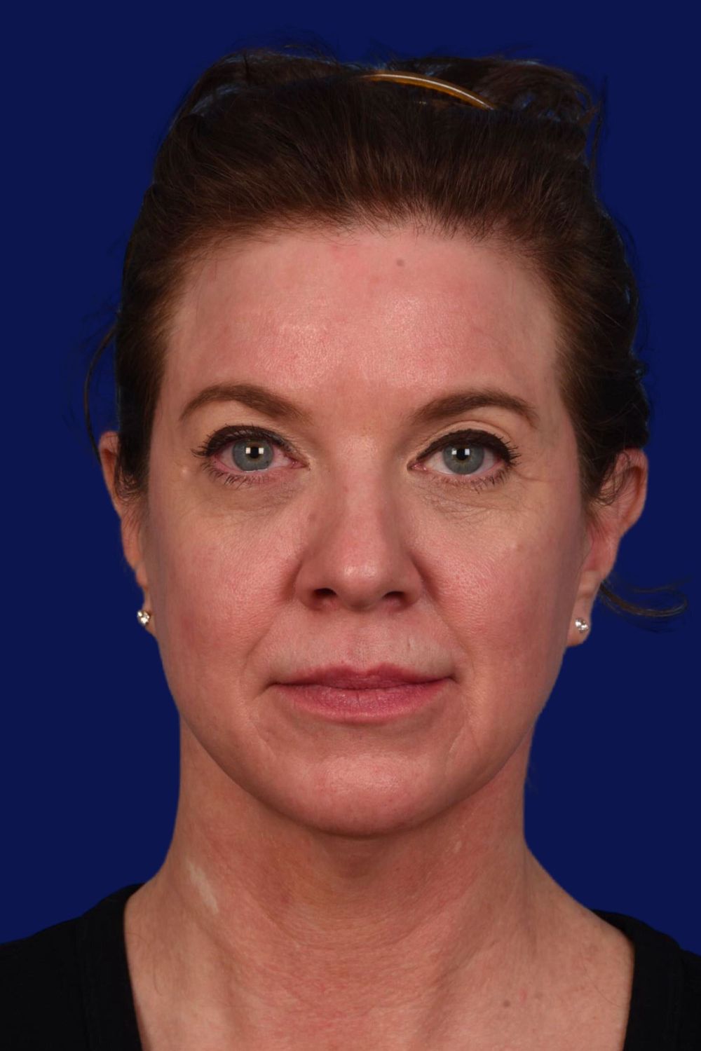 Facial Rejuvenation Before & After