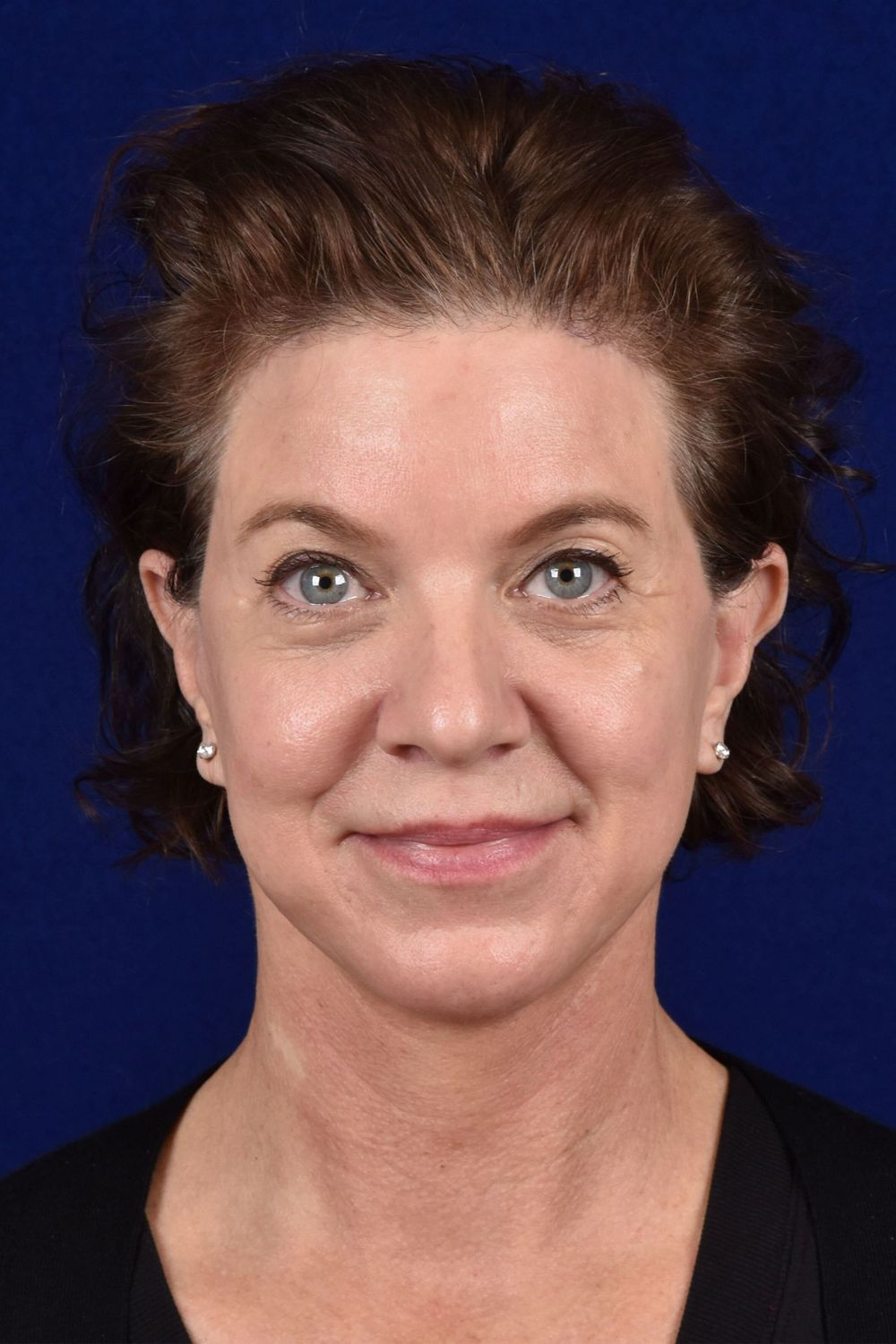 Facial Rejuvenation Before & After