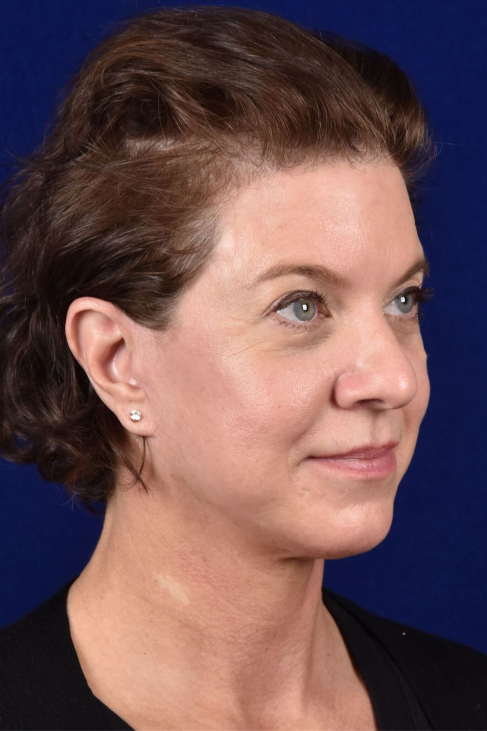 Facial Rejuvenation Before & After