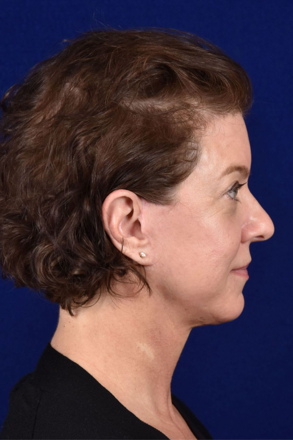 Facial Rejuvenation Before & After