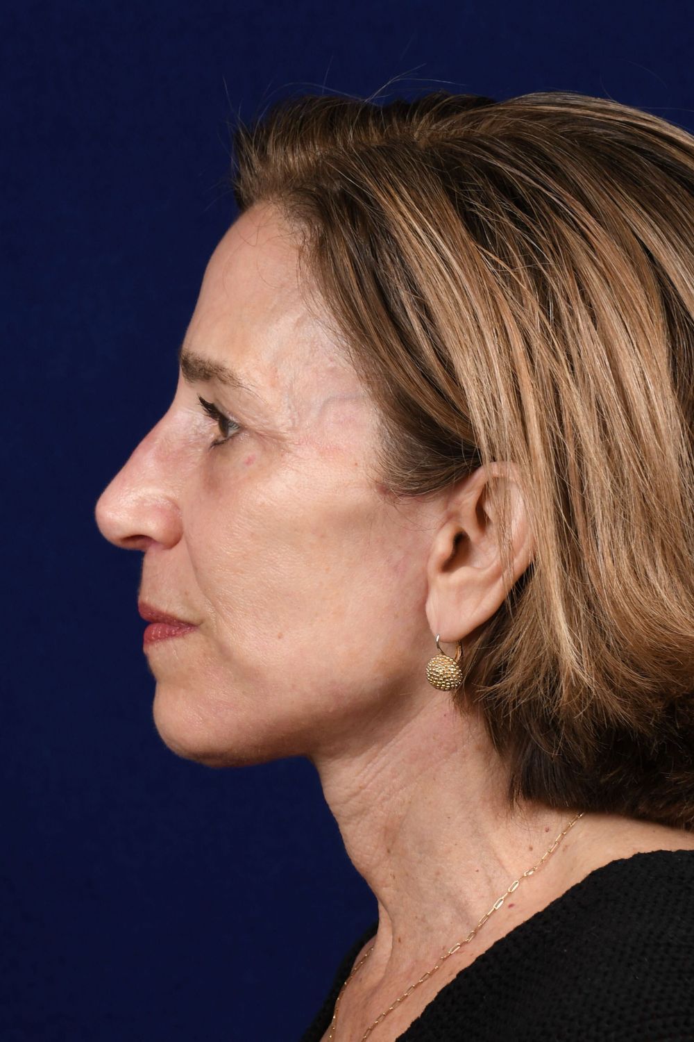 Facial Rejuvenation Before & After