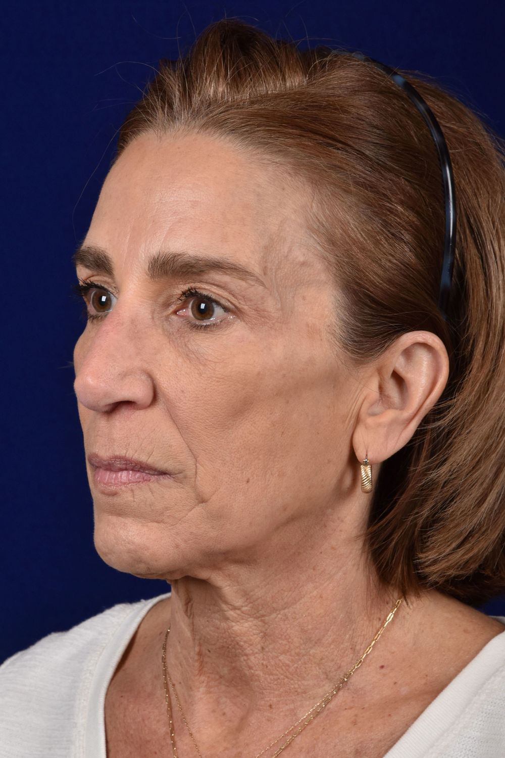 Facial Rejuvenation Before & After