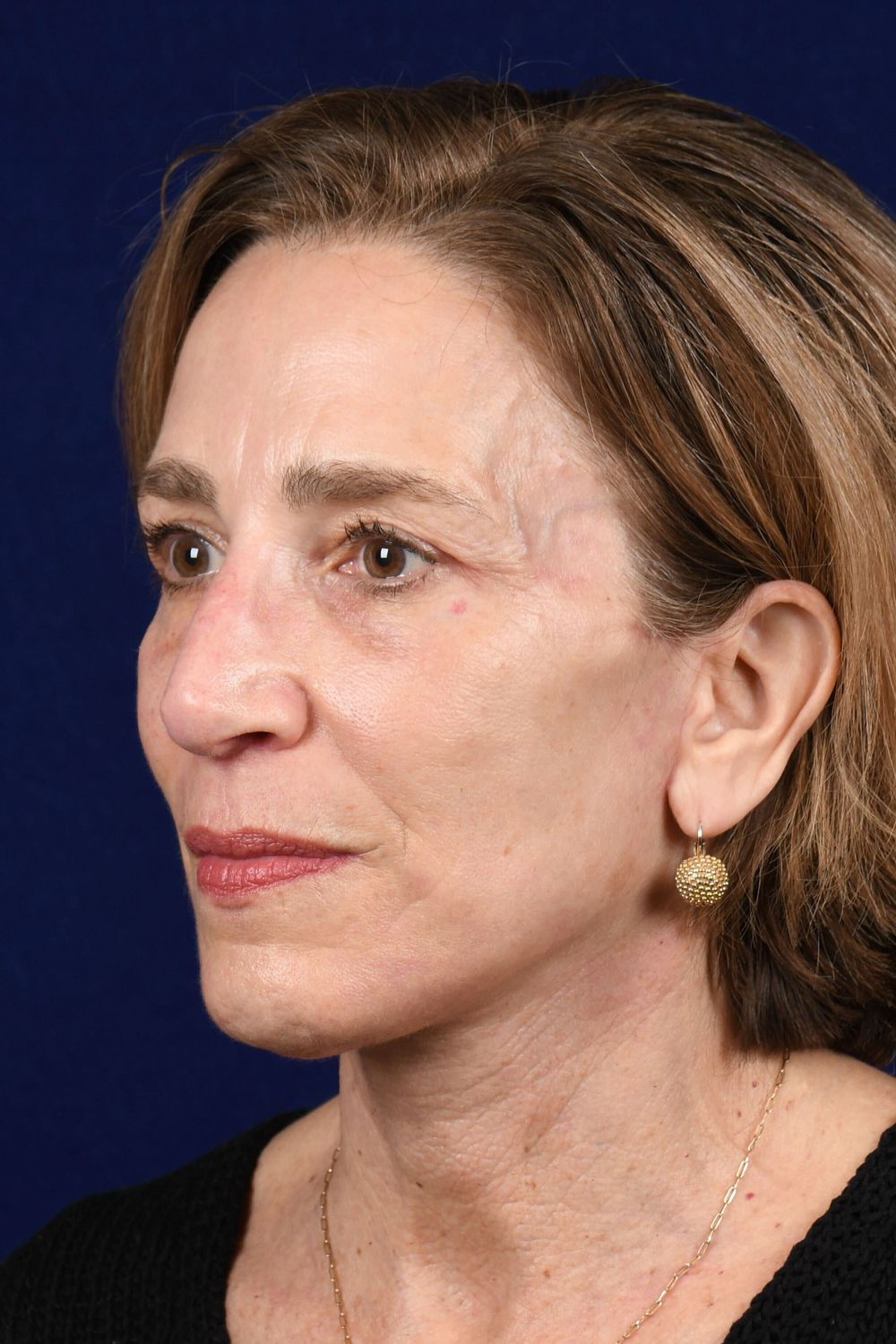 Facial Rejuvenation Before & After